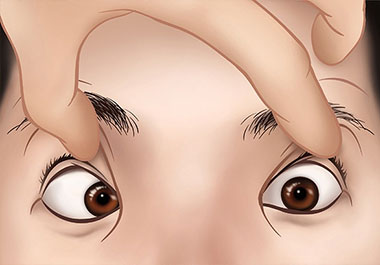 Squint eye surgery in bangalore