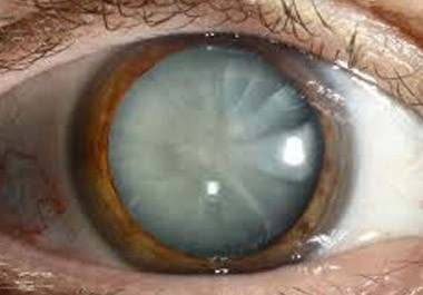 Cataract eye